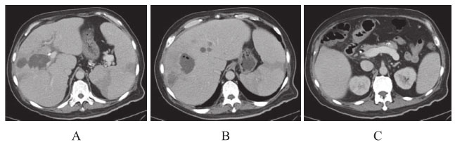 图4 腹部增强CT（第三次入院）